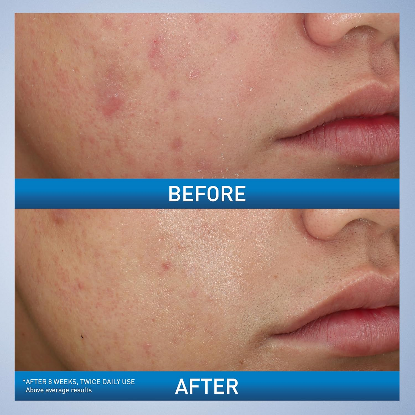 Acne Foaming Cream Wash