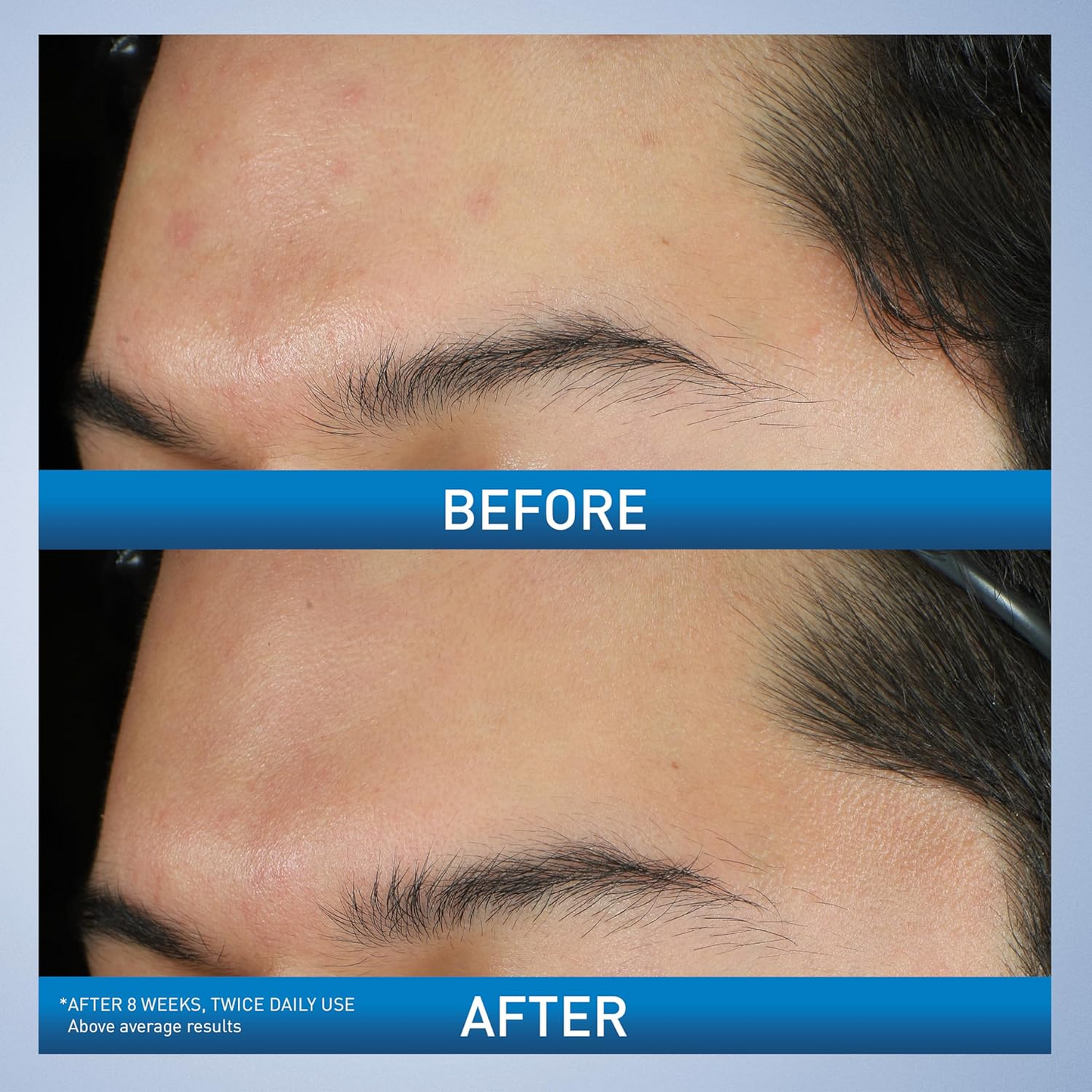 Acne Foaming Cream Wash